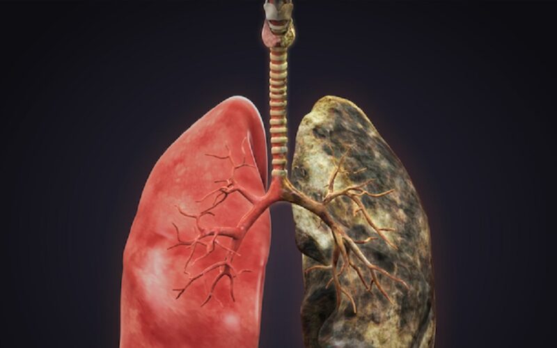 The Causes and Symptoms of Lung Cancer