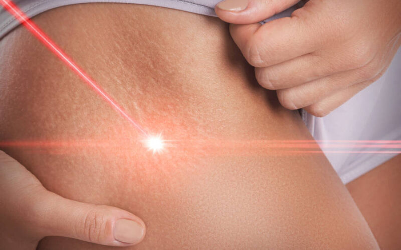 Can a Laser Clean Out My Stretch Marks?￼