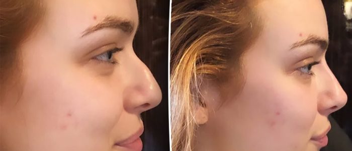 Rhinoplasty Expert: Sculpting Beauty and Function